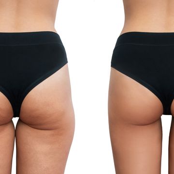 young woman's thighs with cellulite before and after treatment isolated on white background