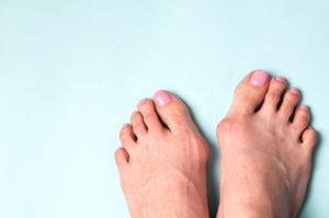 hallux valgus klachten aan de knobbel naast je grote teen