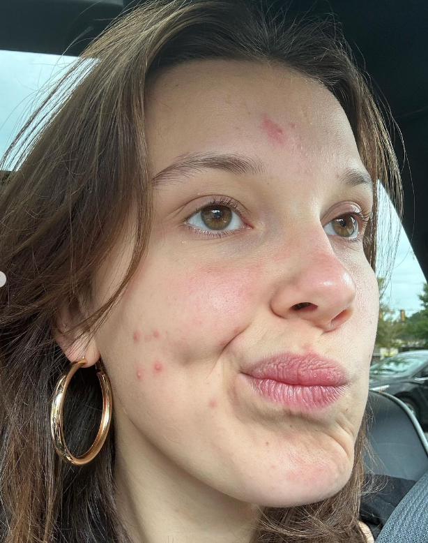 a woman with red spots on her face