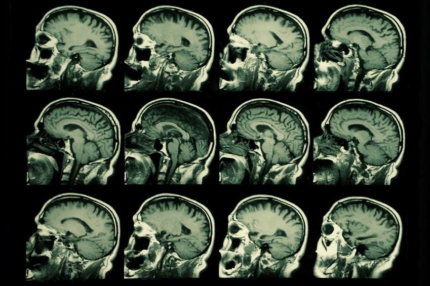 New research from Boston University shows widespread brain damage