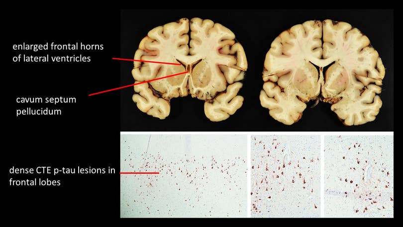 An ex-NFL player who killed six people and then himself had CTE, doctors  say