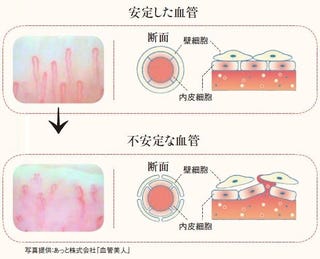 毛細血管クライシス 更年期は要注意 血管モレ とは