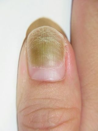 爪のお悩み ジェルネイルをとったら 爪が緑色 困る グリーンネイル 対策