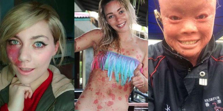 Women with Rare Skin Conditions - Women Speaking Out 