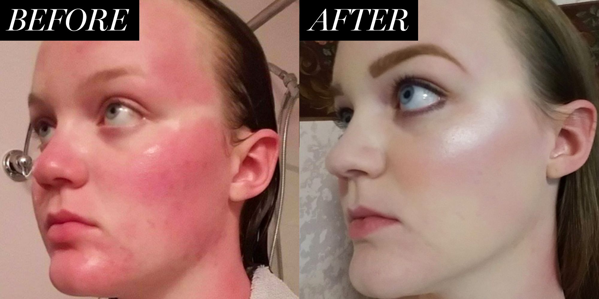 Best Foundation To Cover A Sunburn Reddit Sunburn Foundation