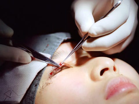 Eye Surgery 1007 Double eyelid surgery.