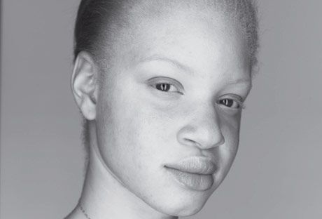 albino black person - Kenosha Robinson - people with albinism
