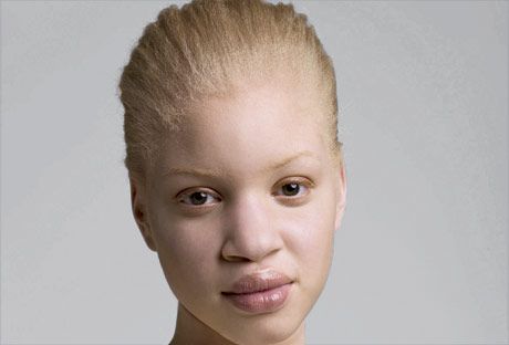 Albino Black Person Kenosha Robinson People With Albinism