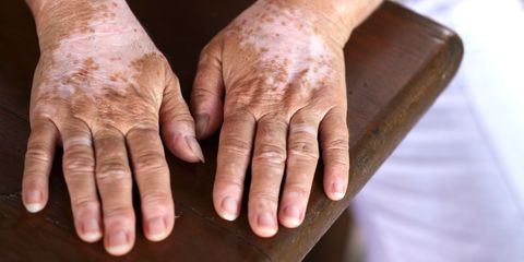 Penis vitiligo Penile Discoloration: