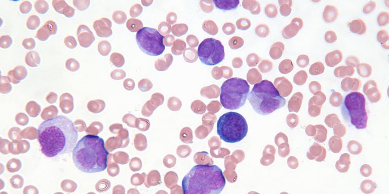 Chronic lymphocytic leukaemia