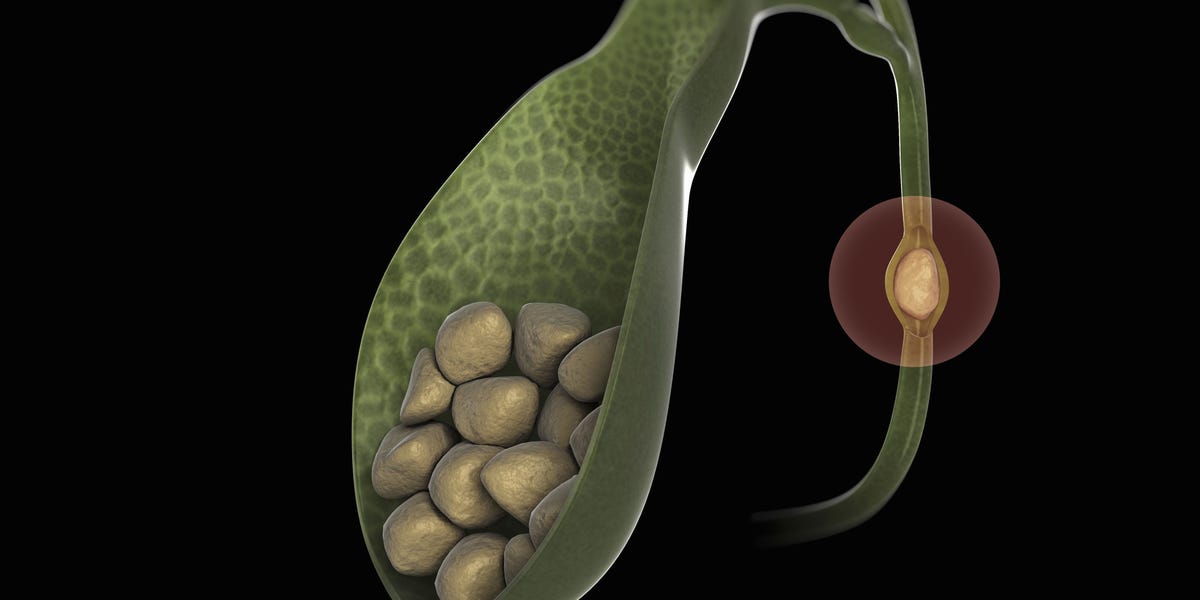 Can Gallstones Affect Conception