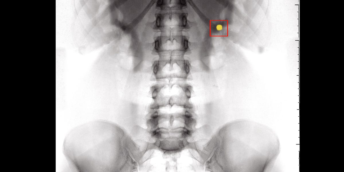 pictures of kidney stones in the liver