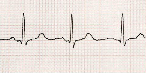Echocardiogram (ECHO)
