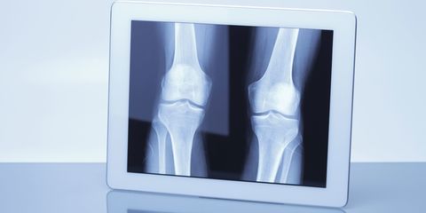 x-ray of knees on a tablet