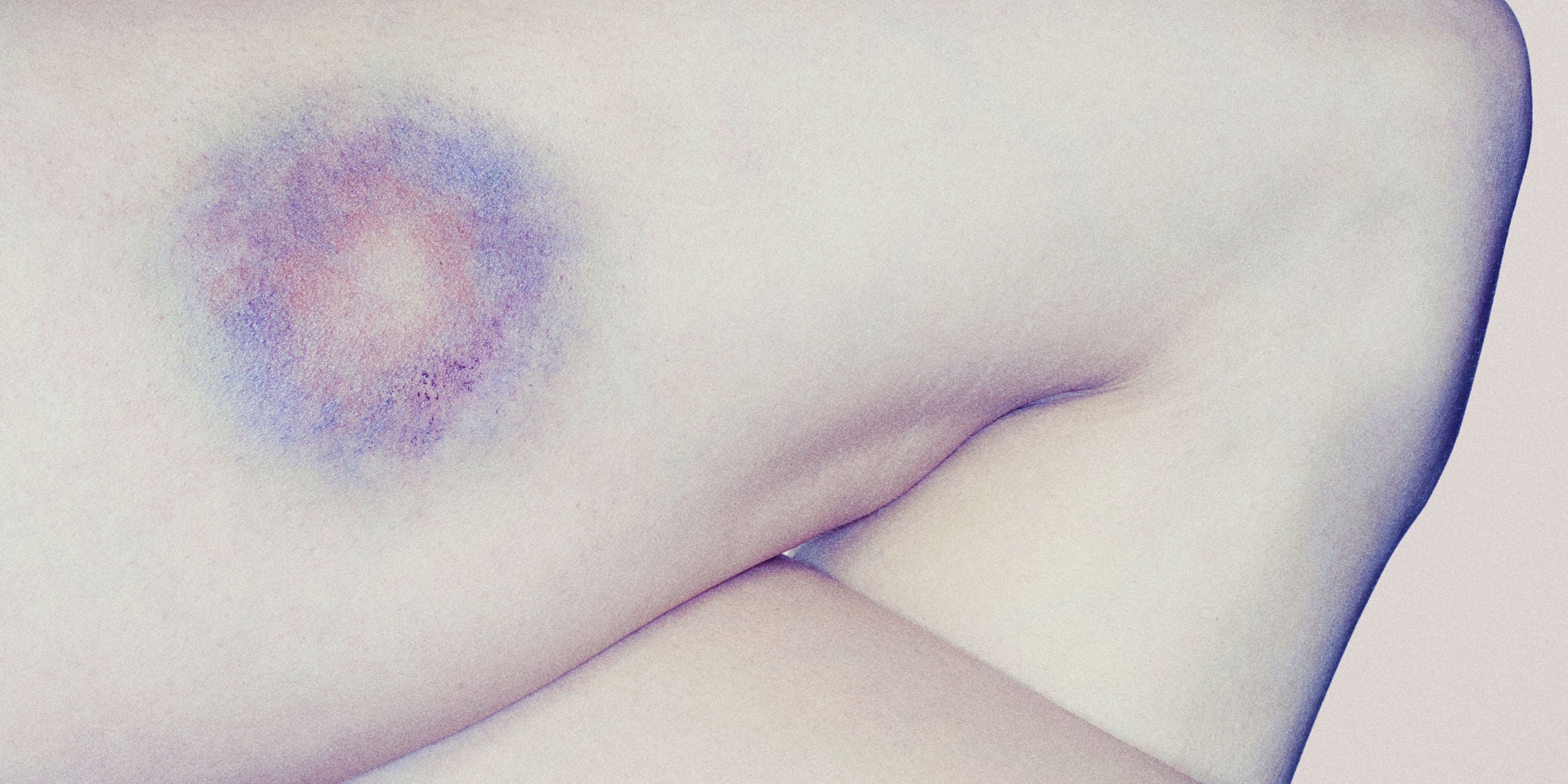 bruise on shoulder