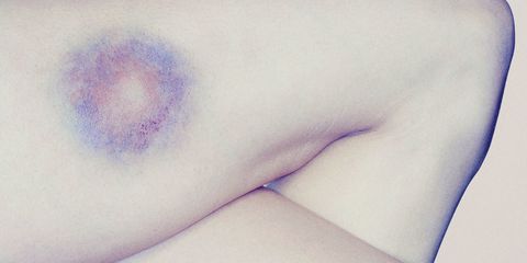 Bruise on thigh
