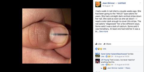 Black line on nails could be melanoma symptom