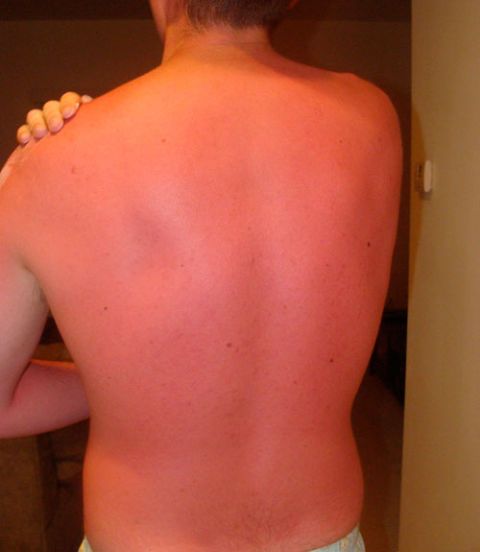 Sunburn Severity Chart