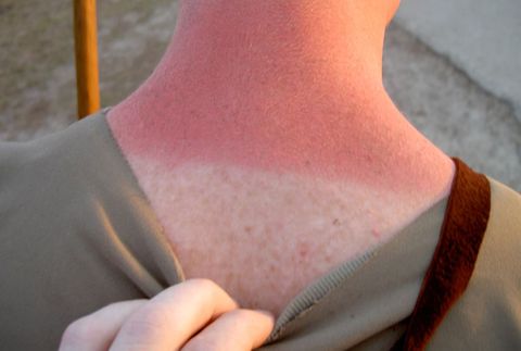stages of a sunburn