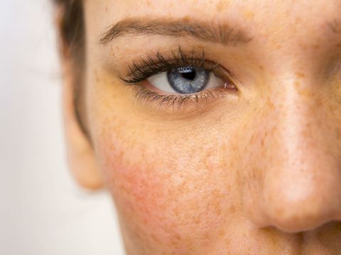 Hyperpigmentation: What it is and how to deal with it