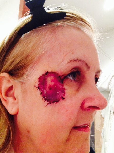 Woman Who Says She Got Skin Cancer From Driving Her Car Shares An