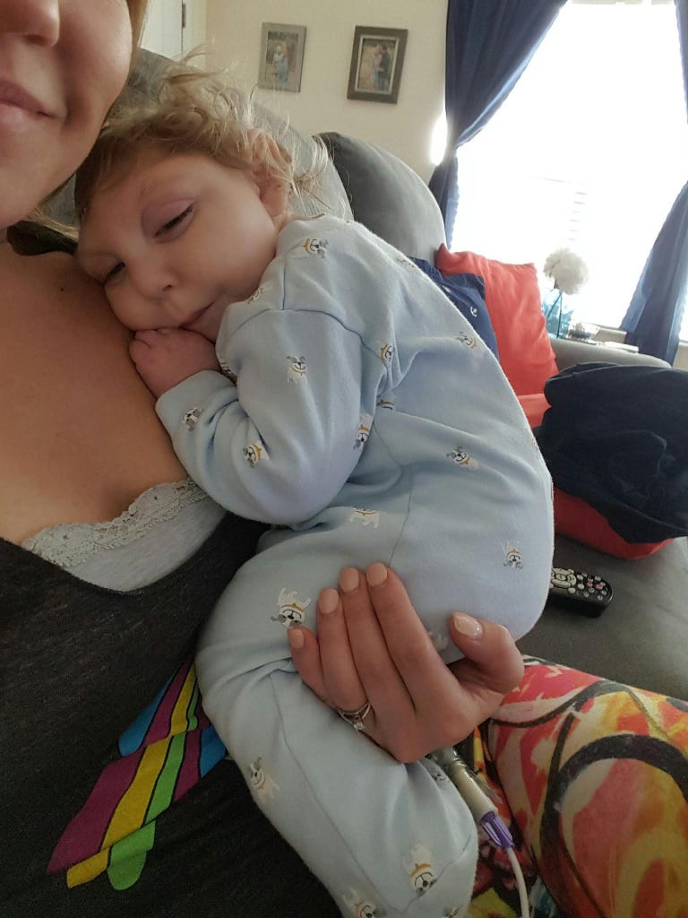 Jaxon Strong, Miracle Baby Born With Most of His Skull Missing, Just ...