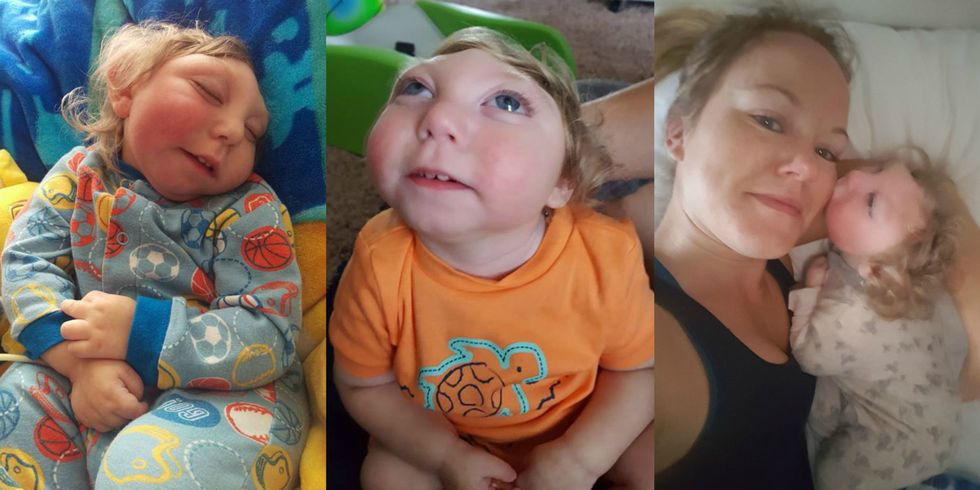 Jaxon Strong, Miracle Baby Born With Most of His Skull Missing, Just ...