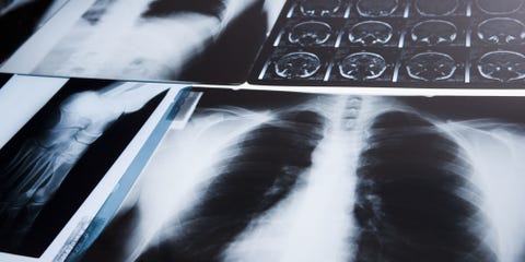 Get This Test When You Turn 45 <p>"Bone scans generally aren't recommended until age 65, but many women should start them much earlier. <a href="http://www.redbookmag.com/body/a47371/health-secretary-tom-price-abortion-birth-control-cost/" target="_blank" data-tracking-id="recirc-text-link">Most insurance policies</a> will cover them if you have at you use these meds as directed, they're least one risk factor for osteoporosis, like a family history or a petite frame. So I tell women who I think could be at risk to ask their doctor about a scan at age 45. Here's why: Your first bone density scan, known as DXA, is a baseline exam, just like <a href="http://www.redbookmag.com/body/health-fitness/advice/g3825/fighting-breast-cancer/" target="_blank" data-tracking-id="recirc-text-link">your first mammogram</a>. Bone loss begins at menopause, so if we don't do a DXA scan until years later, we have no idea what your peak bone density was or how fast loss has occurred. So start your scans as soon as possible, and try to have them done at the same facility, in the same machine, every single time—that's where the findings are stored. If you can't do that, it's important to get a copy of your scan, including the images, to give to the new technician." <em data-redactor-tag="em">—David B. Karpf, </em><em data-redactor-tag="em">M.D., clinical professor of endocrinology at Stanford University School of Medicine in California and chair of the Medical and Scientific Advisory Board for the nonprofit American Bone Health</em></p>