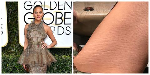 <p>The model and Twitter clapback queen shared a photo of&nbsp;her legs, stretch marks bared in all their glory. Teigen captioned the photo "whatevs," epitomizing her nonchalant attitude towards them. And this isn't even the first time the&nbsp;<em data-verified="redactor" data-redactor-tag="em">Lip Sync Battle</em><span class="redactor-invisible-space" data-verified="redactor" data-redactor-tag="span" data-redactor-class="redactor-invisible-space"> host got candid about her stretchies – she <a href="http://www.redbookmag.com/body/news/a21407/finally-a-model-gets-real-about-stretch-marks/" target="_blank" data-tracking-id="recirc-text-link">shared a similar picture</a> back in April 2015.</span></p>