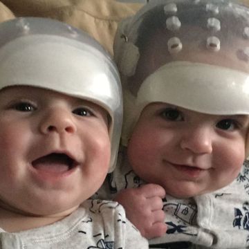 howard triplets born with craniosynostosis