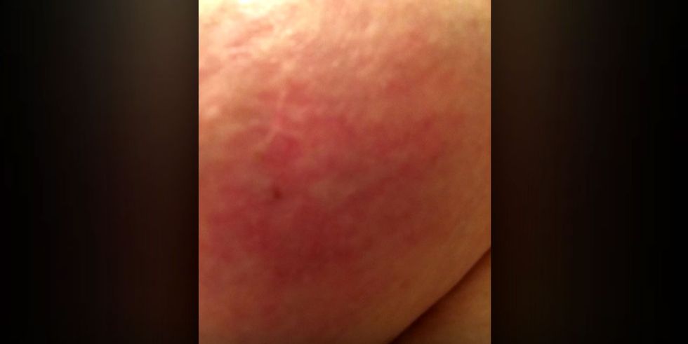 Breast Rash: “Warning” GRAPHIC IMAGES!!! Reality Check For Both