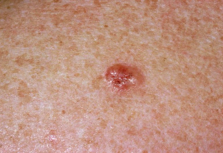 Skin Cancer Warning Signs - What Skin Cancer Looks Like