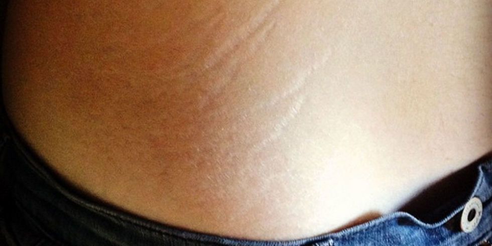 Girls Everywhere Are Embracing Their Stretch Marks In Amazing New Viral Trend
