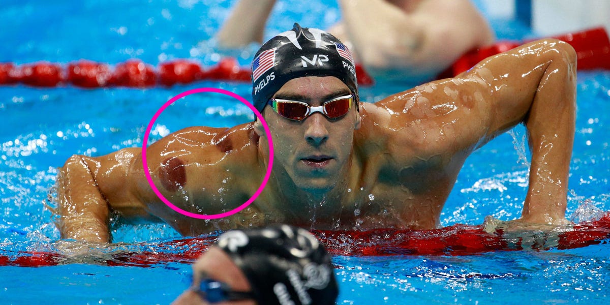 Spots on Michael Phelps - What is Cupping