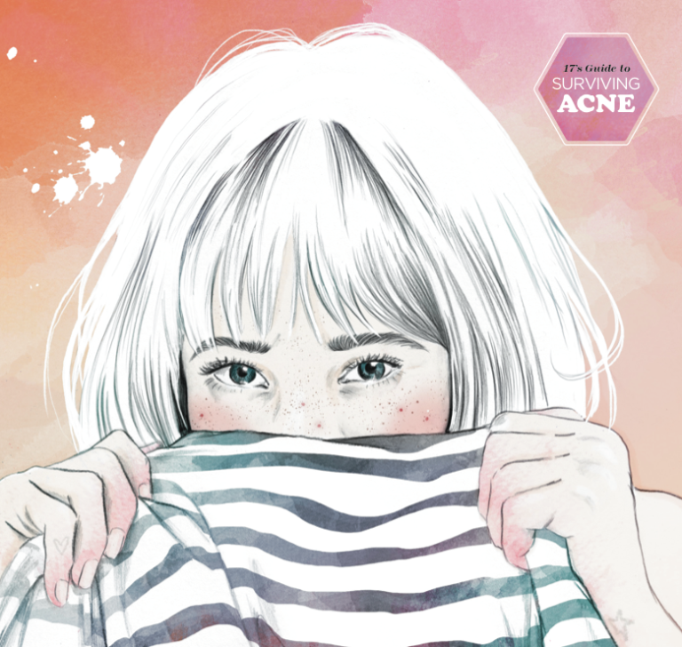 What Causes Acne? - How to Treat Pimples, Breakouts and Skin Problems