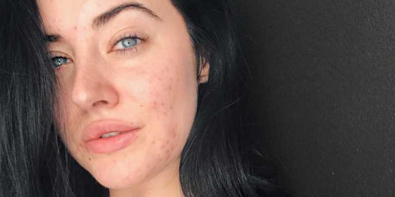 This Model Just Showed Off Her Acne In The Most Empowering Way 1313