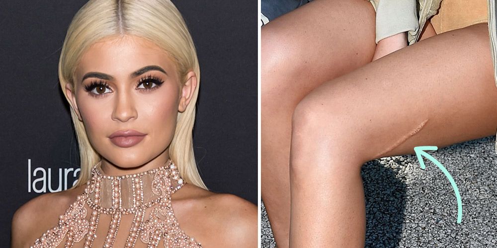 Kylie Jenner Won't Remove Her Scar - Leg Scar