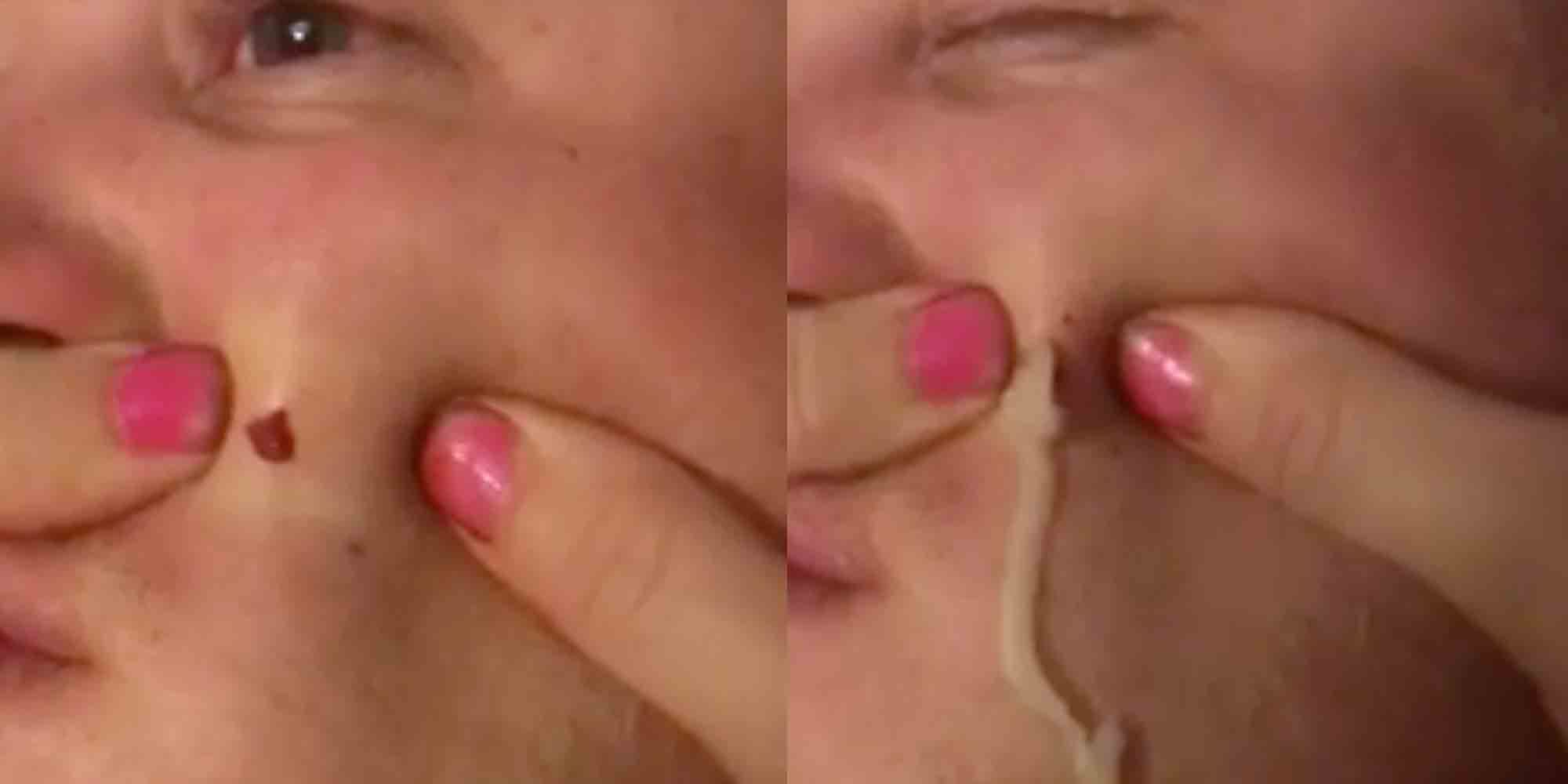 spænding åbning følelsesmæssig 4-Year-Old Pimple Popping Video