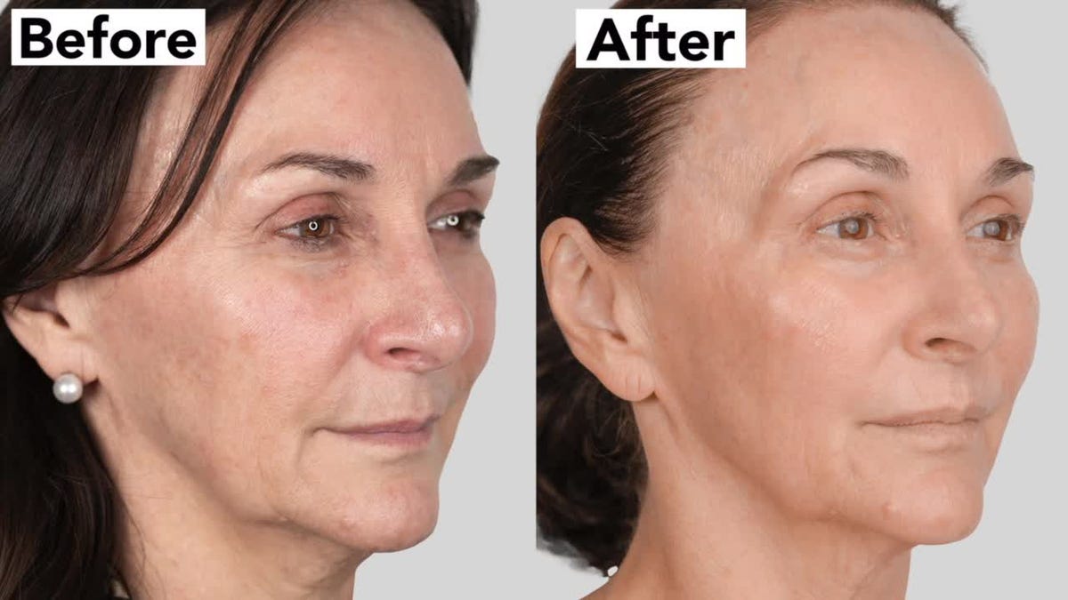 shirley ballas talka about neogen skin treatment and cancelling facelift plans