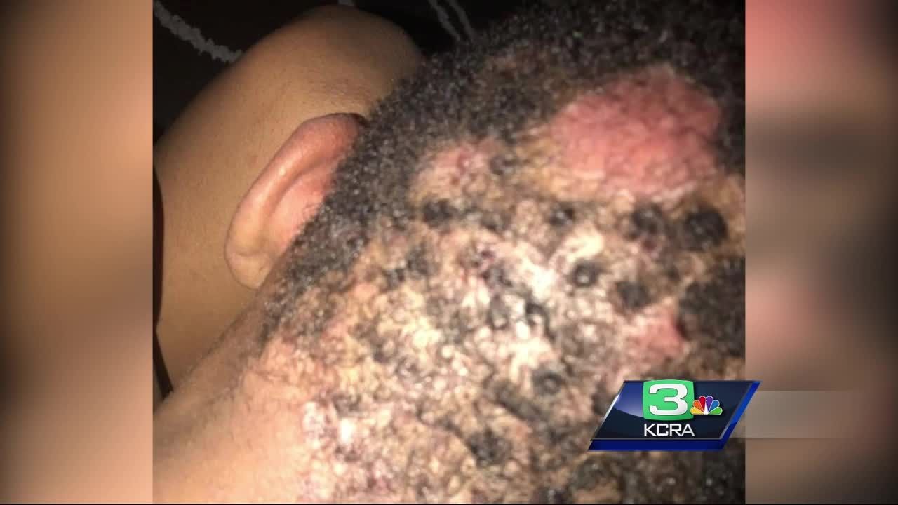 Stockton mother claims son got scalp fungus at barber shop
