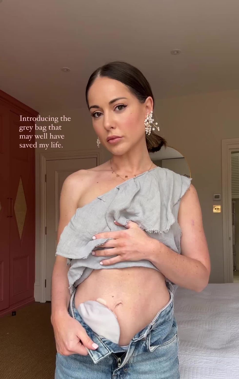 louise thompson shows off her stoma bag for the first time