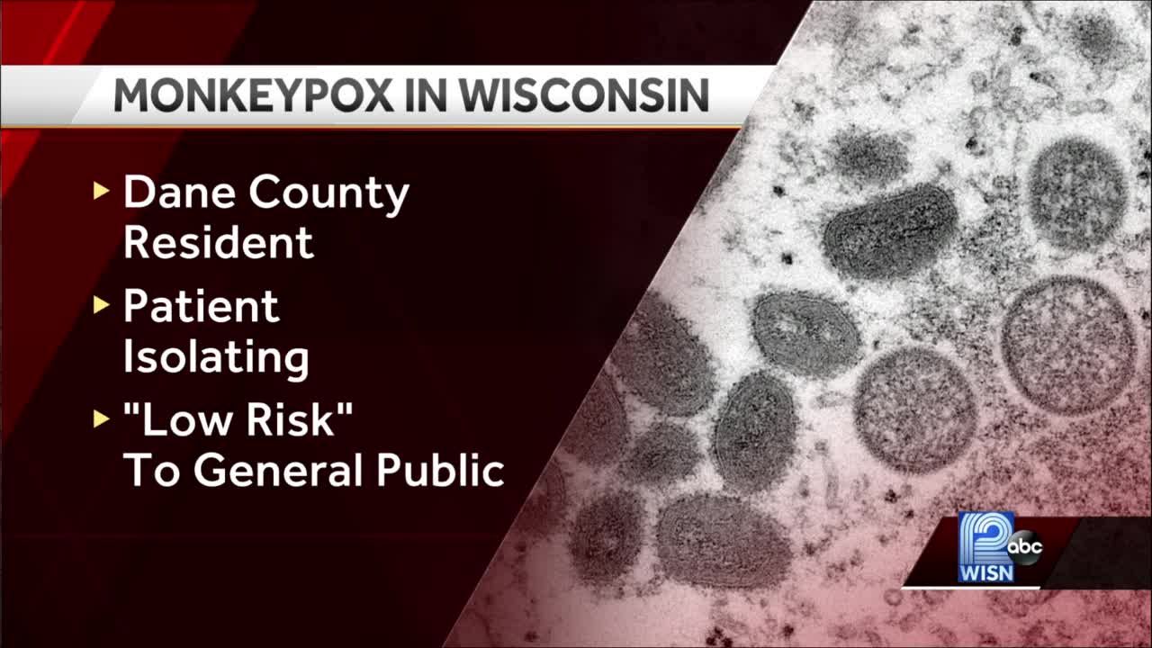 First case of monkeypox confirmed in Wisconsin