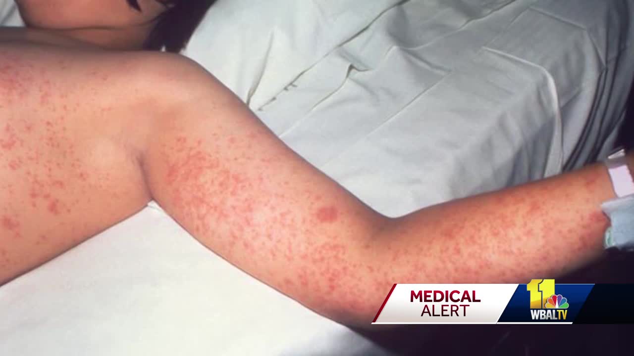 Measles very contagious. Doctor explains how