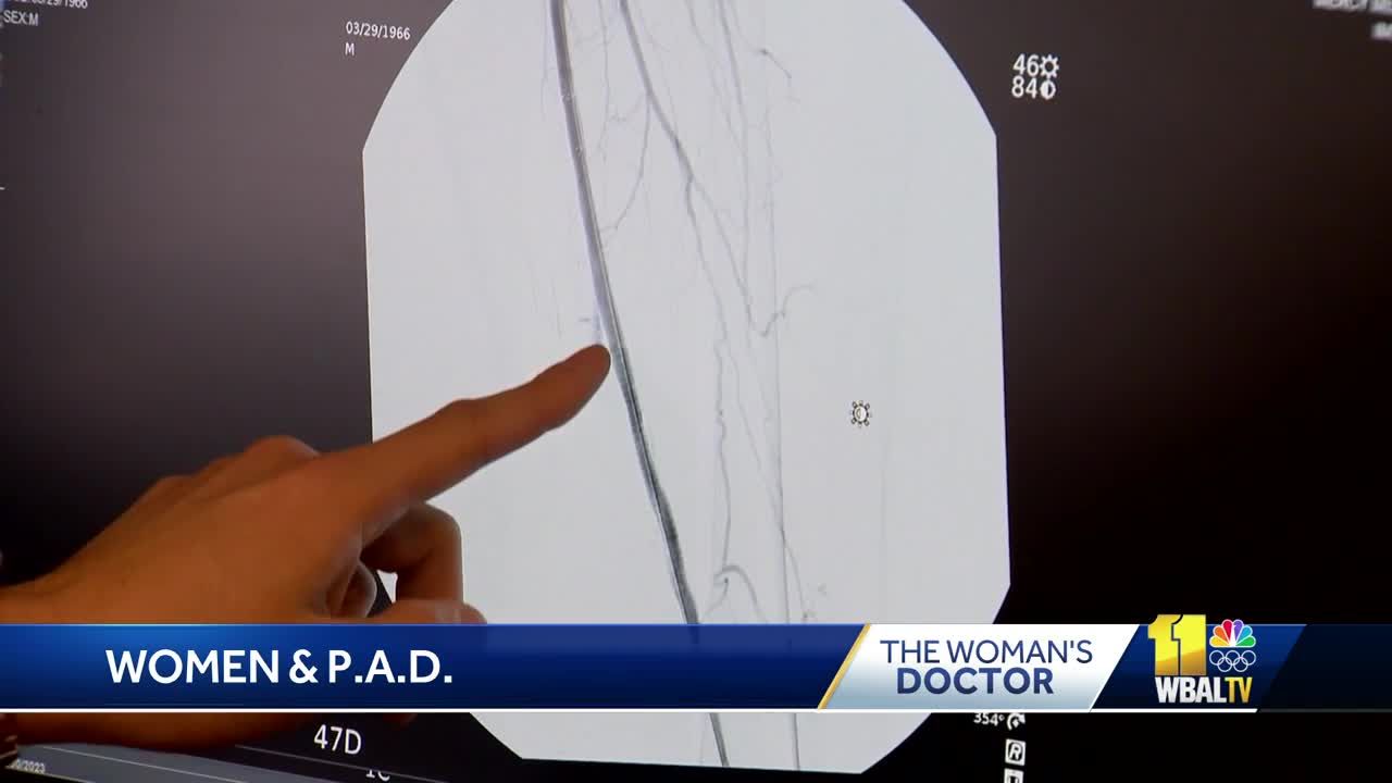 Woman's Doctor: Diagnosing peripheral artery disease or PAD in women