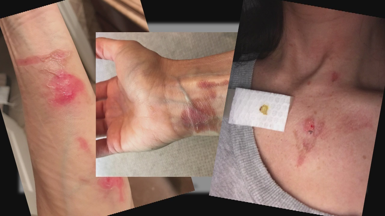 nutribullet injury