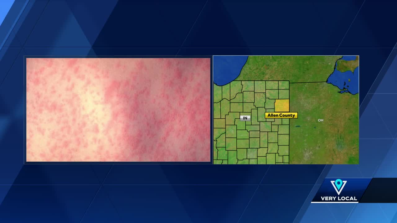 2 more measles cases confirmed in Indiana