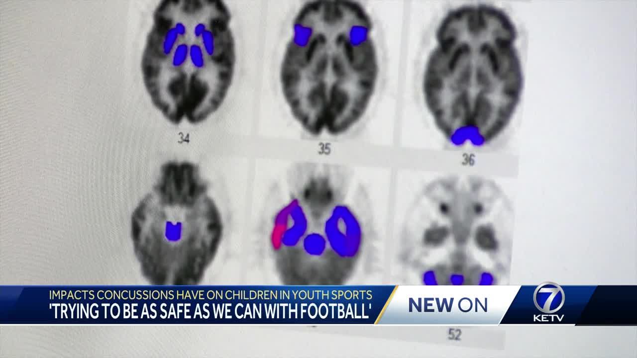 Concussions in Youth Sports: A Doctor Explains