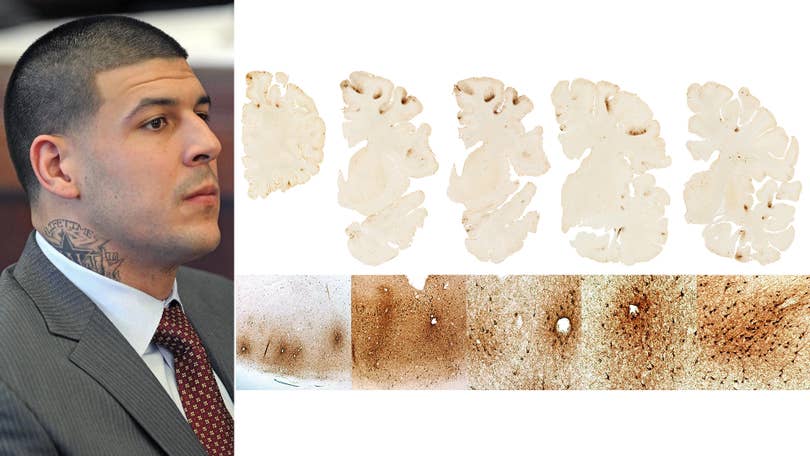 Aaron Hernandez Had Developed Severe CTE by the Time of His Death