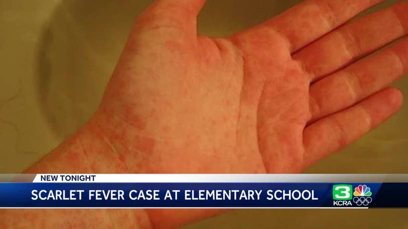 Parents and carers asked to be aware of the symptoms of scarlet fever