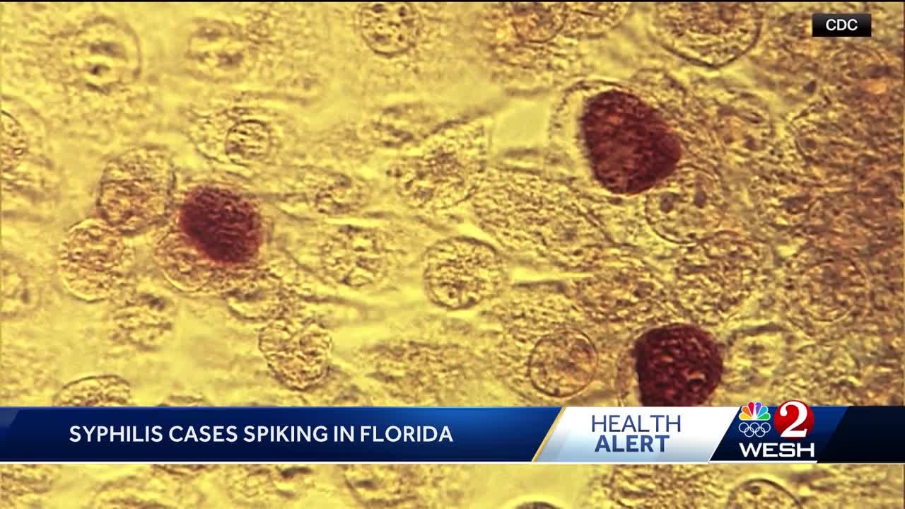 Syphilis cases surging in Florida, data shows